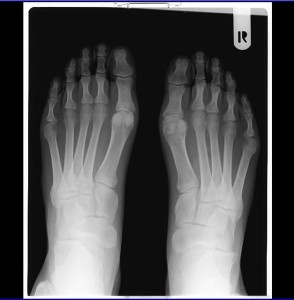Getting to Know Gout